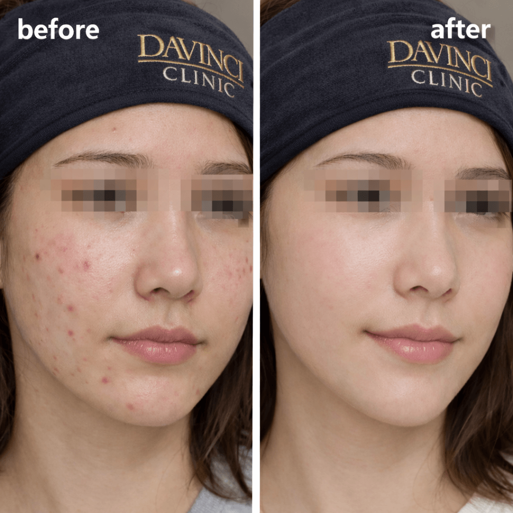 Rejuran Acne Testimonial