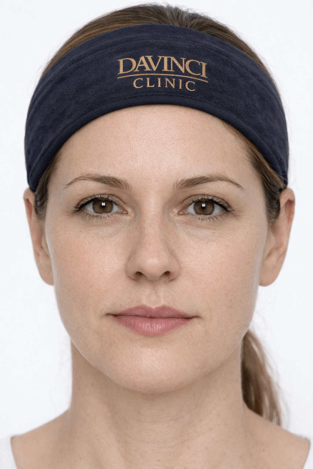 Patient A under-eye after 4 weeks of Collaju treatment