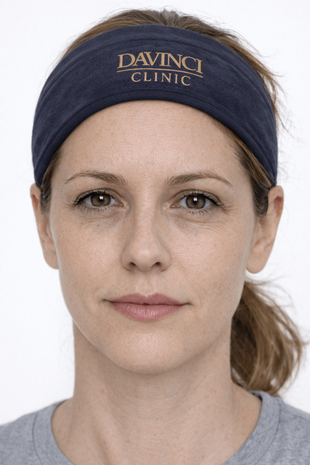 Patient A under-eye before Collaju treatment