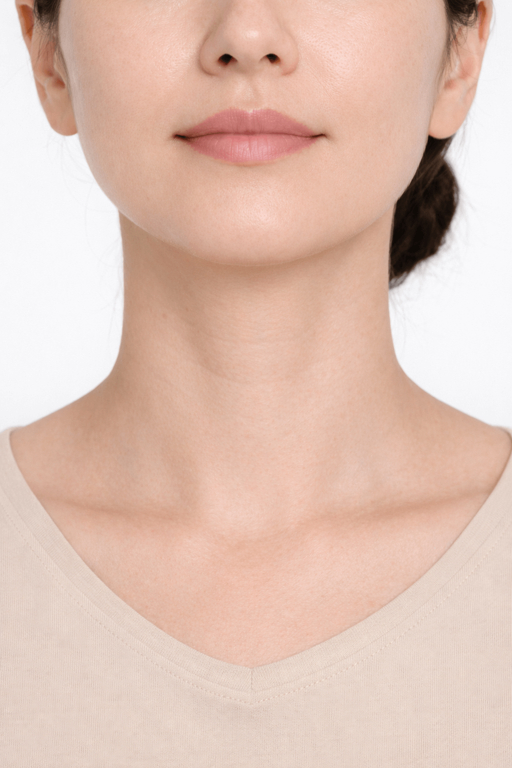 Patient B neck after 4 weeks of Collaju treatment