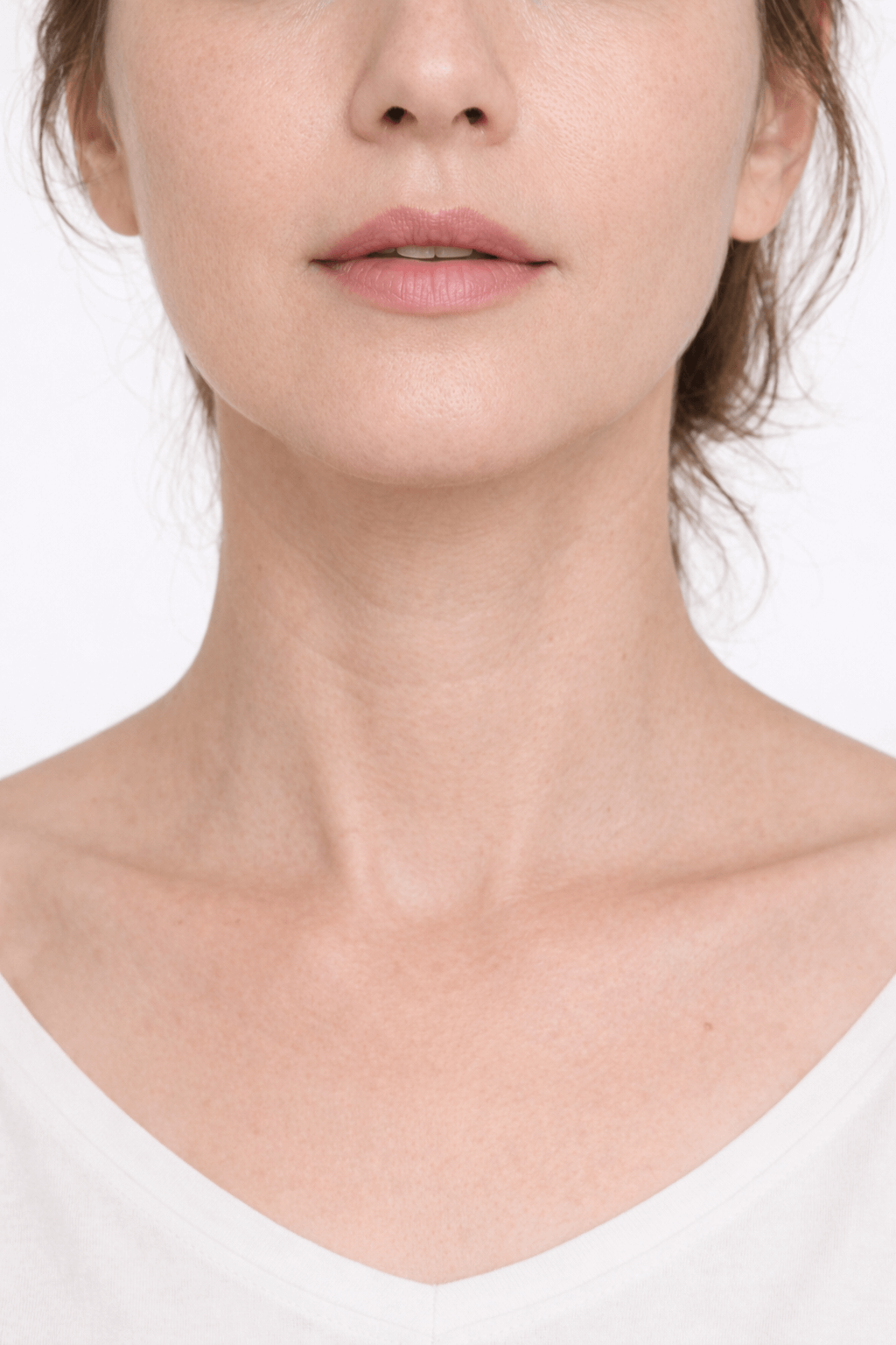 Patient B neck before Collaju treatment