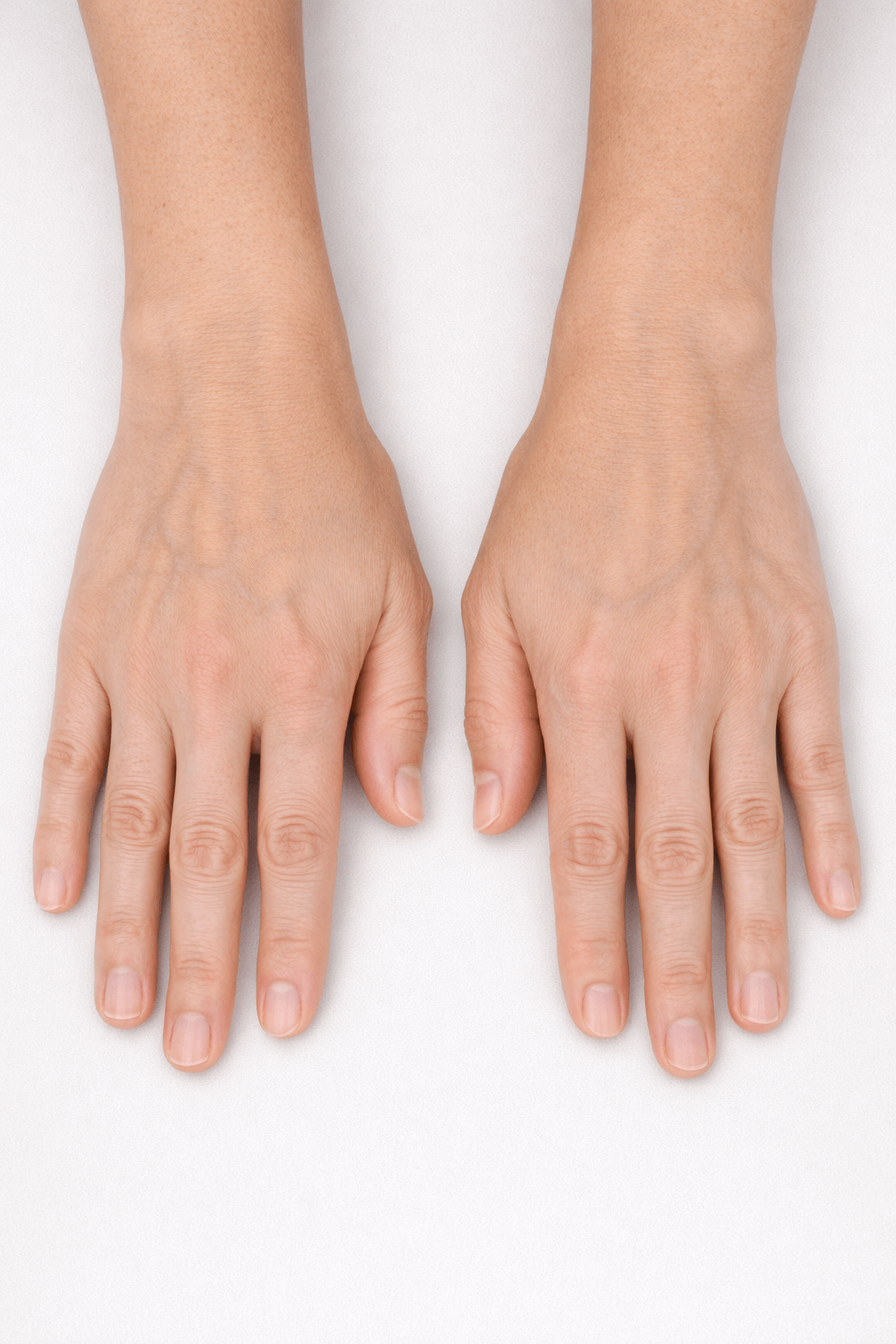 Patient C hands after 4 weeks of Collaju treatment