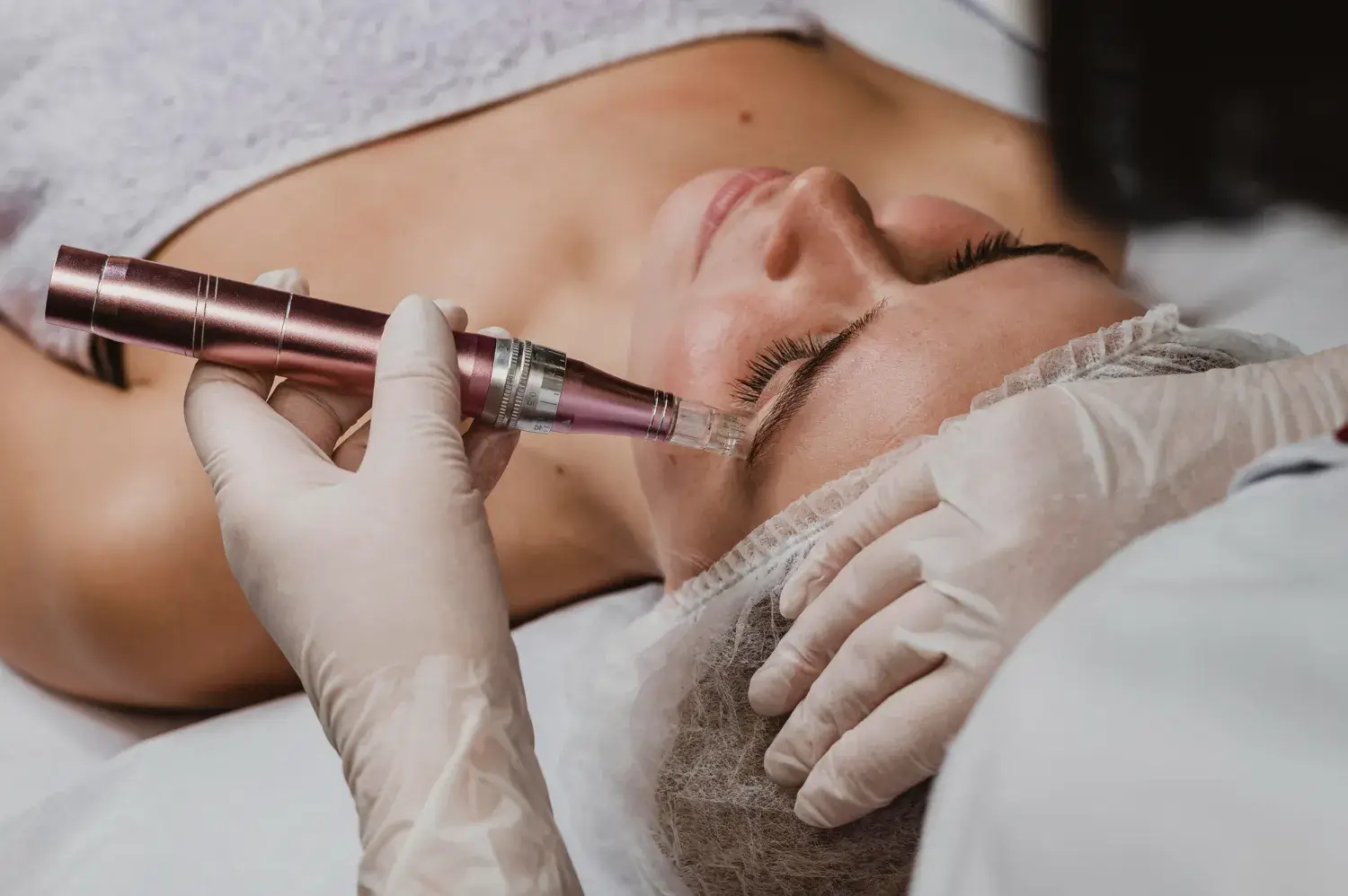 Microneedling Treatment vs Laser