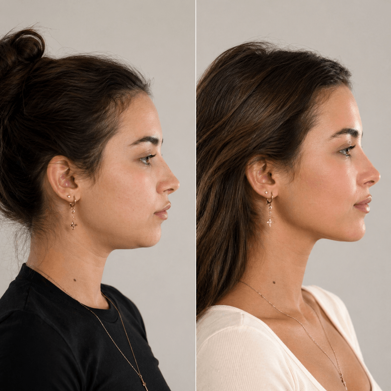 Before and after visual reference for jowl line and sagging jawline treatment