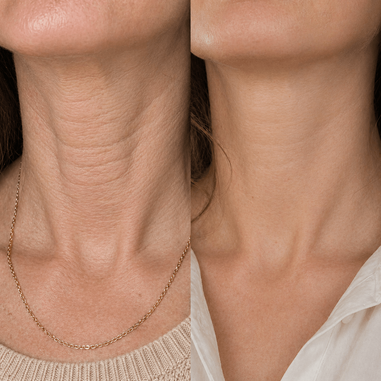 Before and after visual reference for neck tightening and loose neck skin