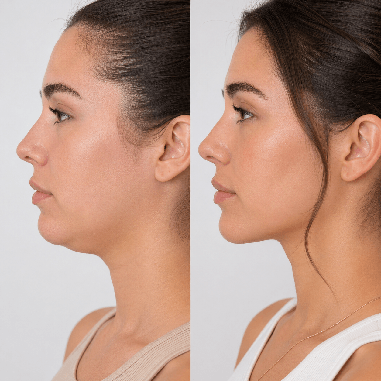 Before and after visual reference for double chin and loose skin under chin
