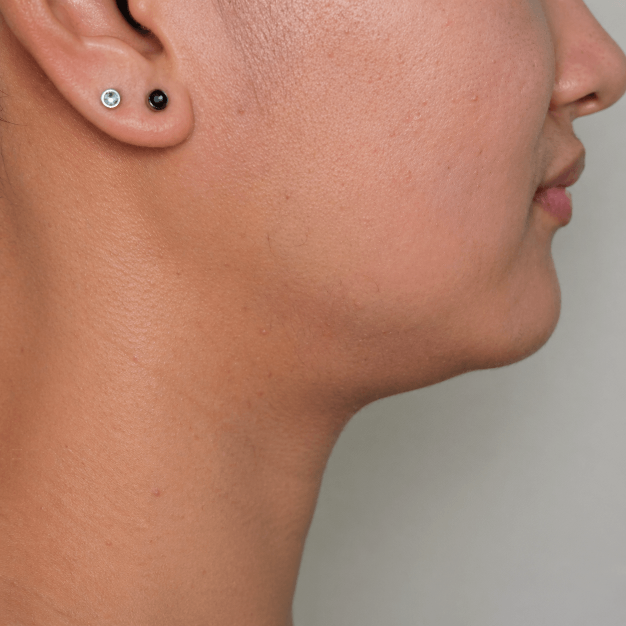 Sagging jawline and lower face laxity