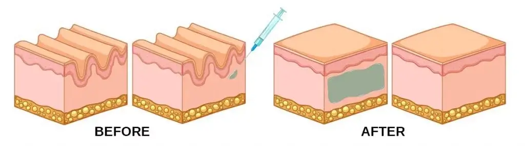 Ellanse Dermal Filler treatment at Da Vinci Clinic Malaysia