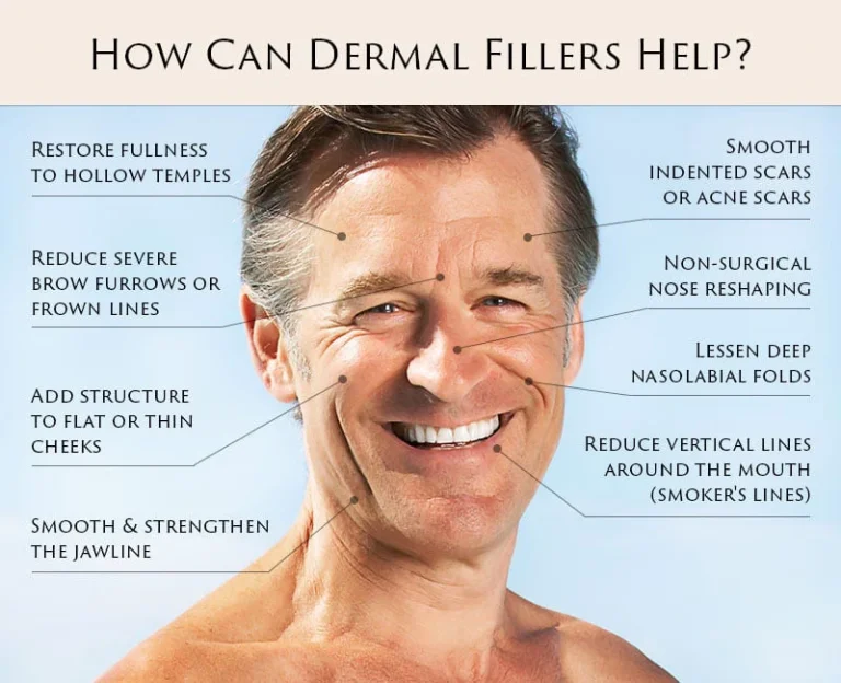 This image shows the benefits of Dermal Fillers on a male face