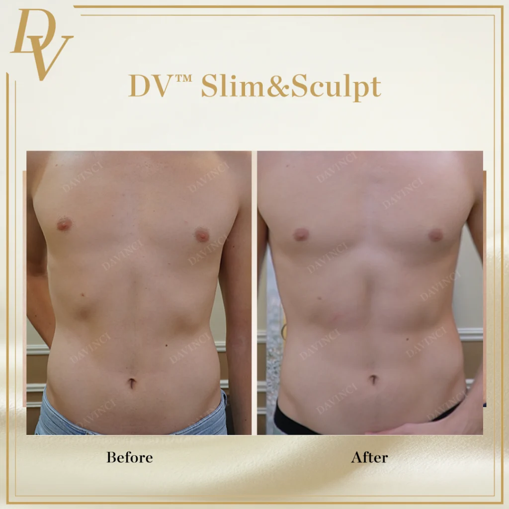 Body Contouring Treatment at Da Vinci Clinic KL