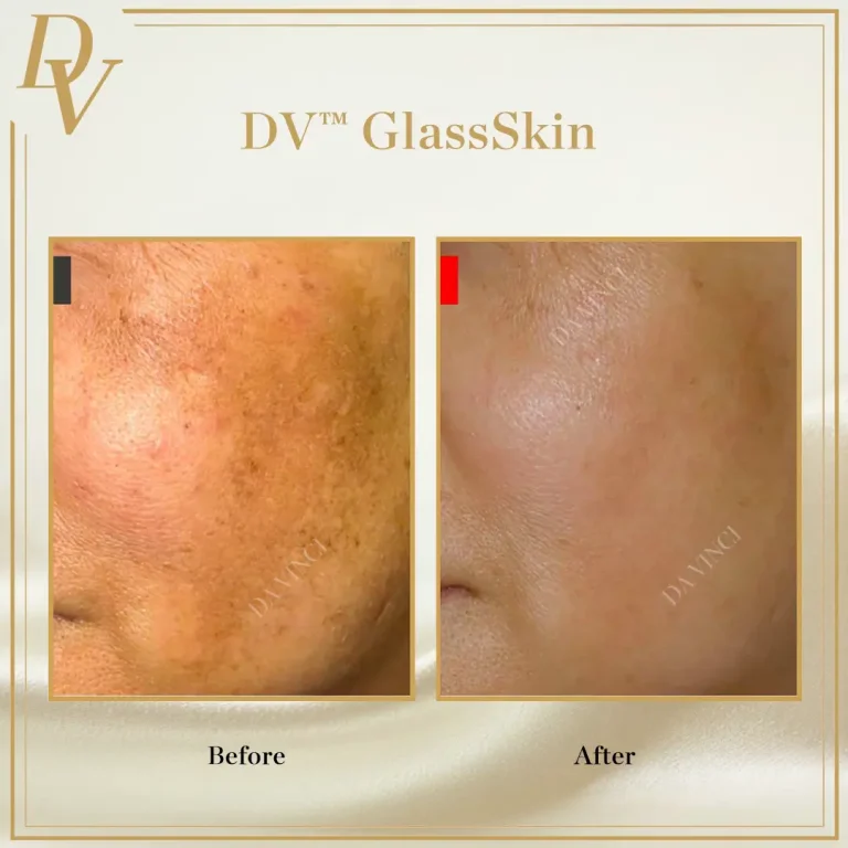 Uneven skin tone treatment at Da Vinci Clinic Kuala Lumpur