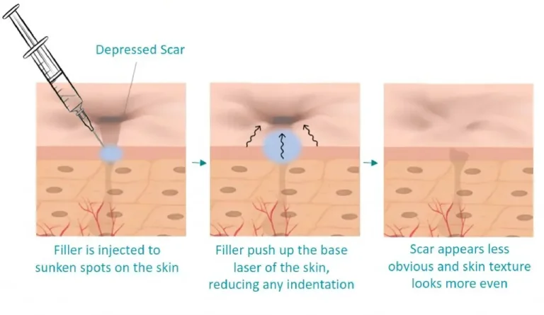 Dermal Fillers helps with depressed or acne scars by improving your skin quality. Giving a more rejuvenated and even skin texture