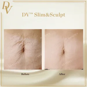 Fat Loss Reduction with DV Slim & Sculpt