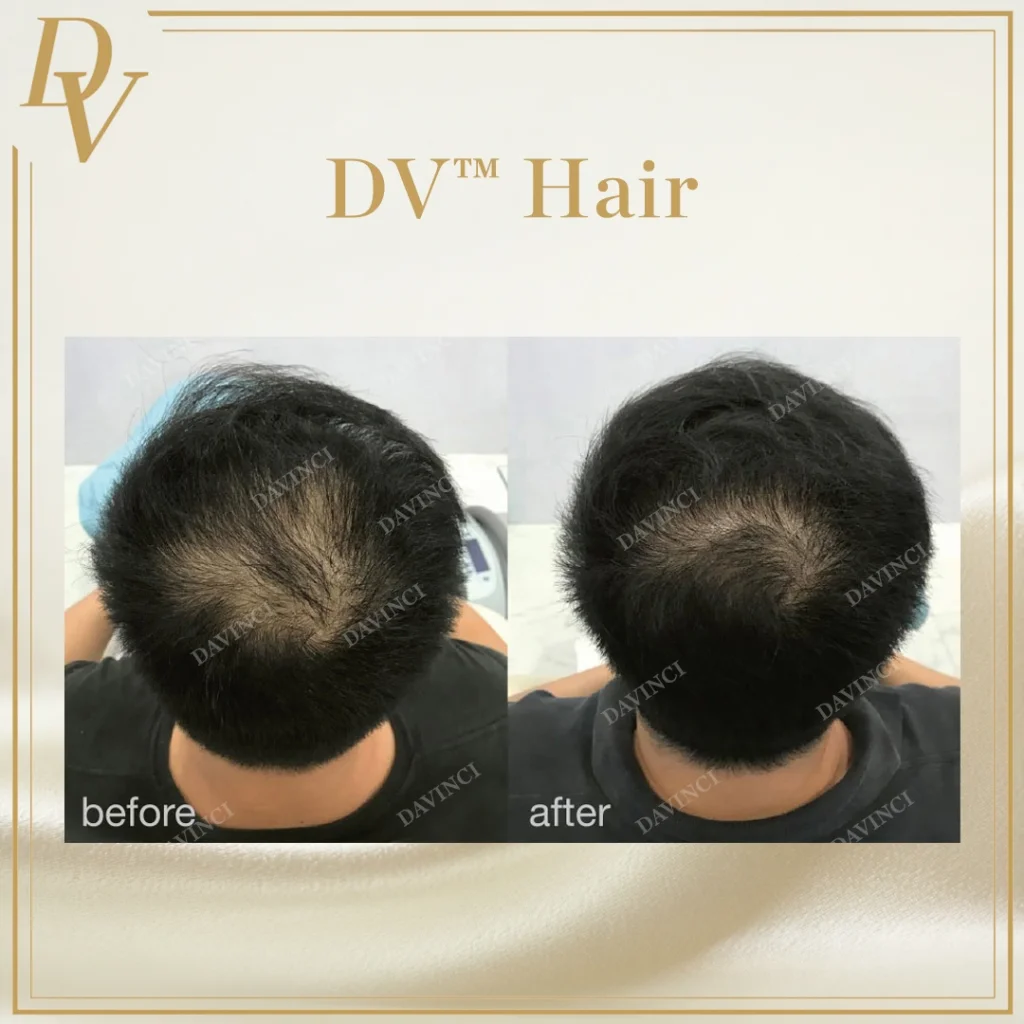 Da Vinci Skin & Aesthetic Clinic Hair Restoration treatment in Kuala Lumpur