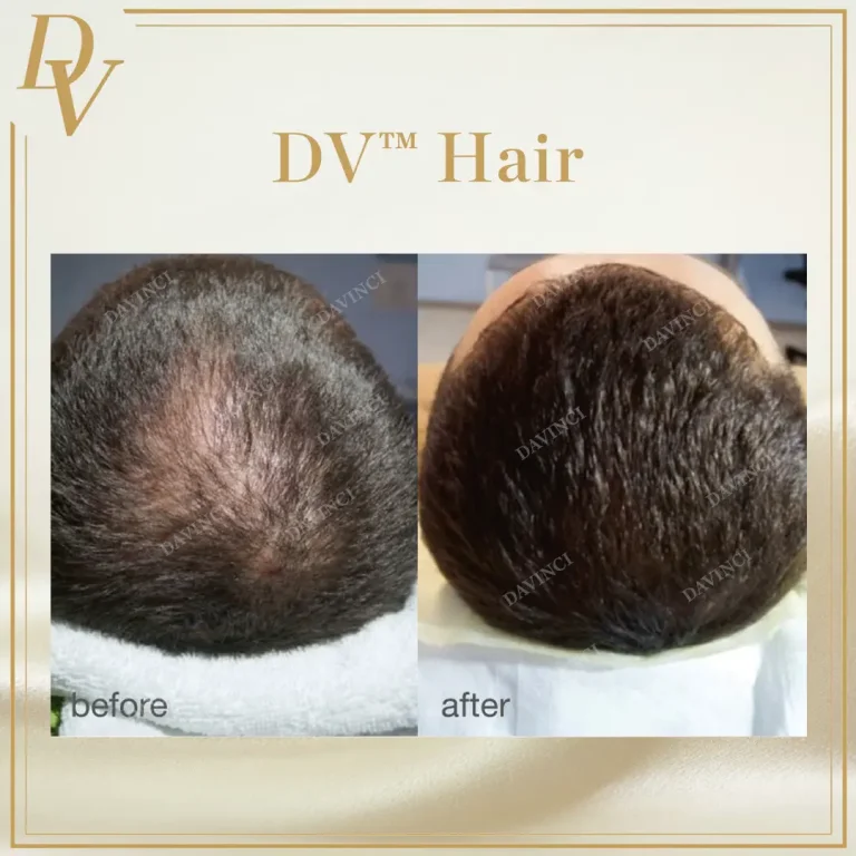Da Vinci Skin & Aesthetic Clinic Hair Restoration treatment in Kuala Lumpur