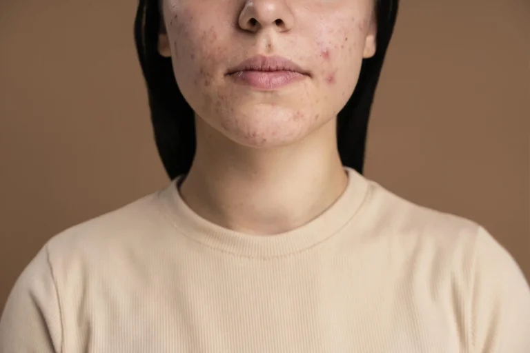 acne scar treatment in malaysia