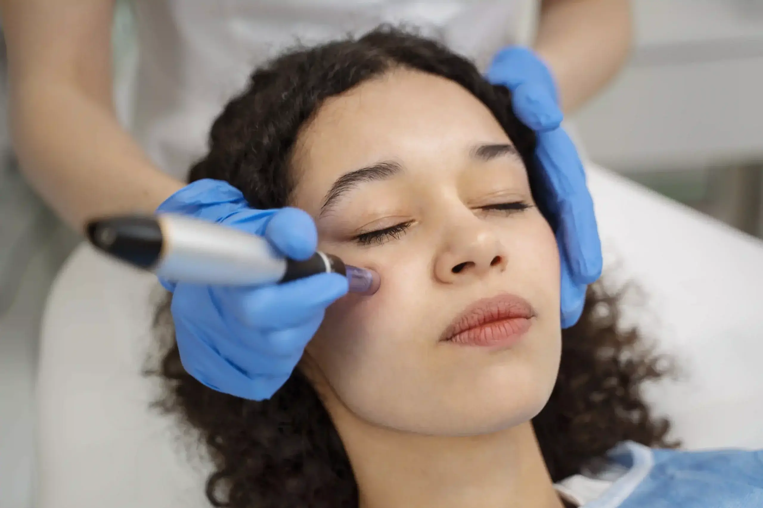 Microneedling Treatment Benefits and Risks