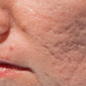 Rejuvenate and smoothen your acne scars with Pico Lasers at Da Vinci Skin & Aesthetic Clinic Malaysia