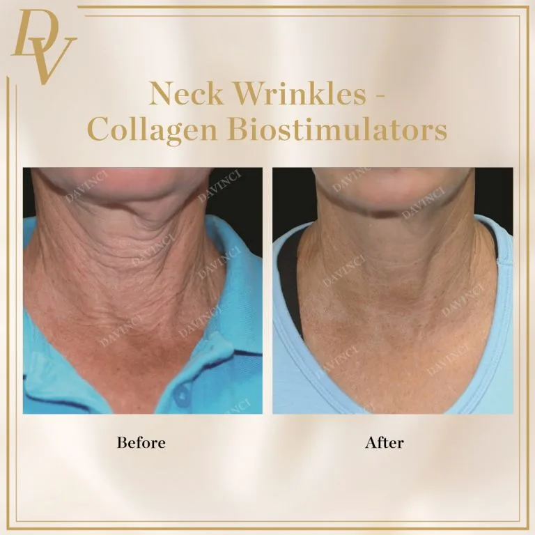 AestheFill Treatment for Neck Wrinkles with Bio-stimulator at Da Vinci Skin & Aesthetic Clinic in Malaysia