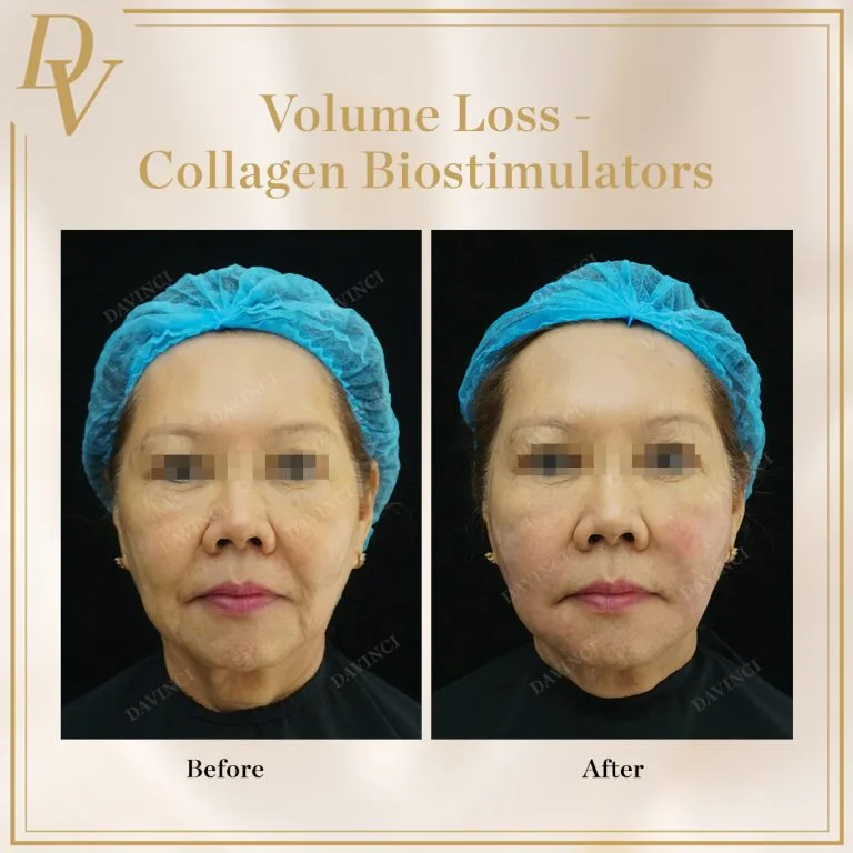 AestheFill Treatment for Volume Loss with Bio-stimulator at Da Vinci Skin & Aesthetic Clinic in Malaysia
