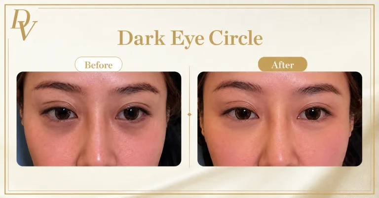 Dark eye circles treatment in Malaysia guide by Da Vinci Clinic, covering causes, types and under-eye treatment options.