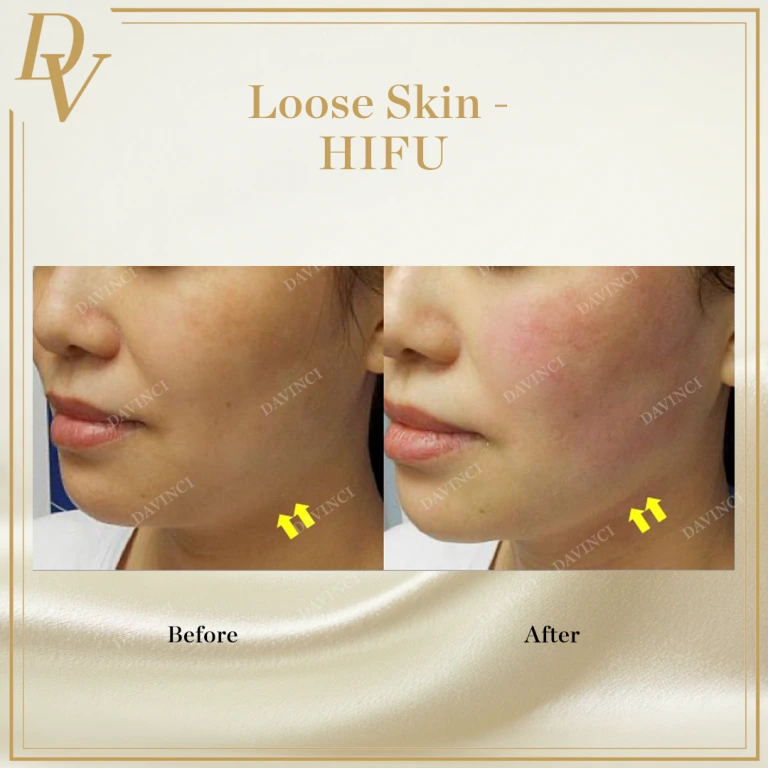 Loose or Saggy Skin treatment with HIFU facelift
