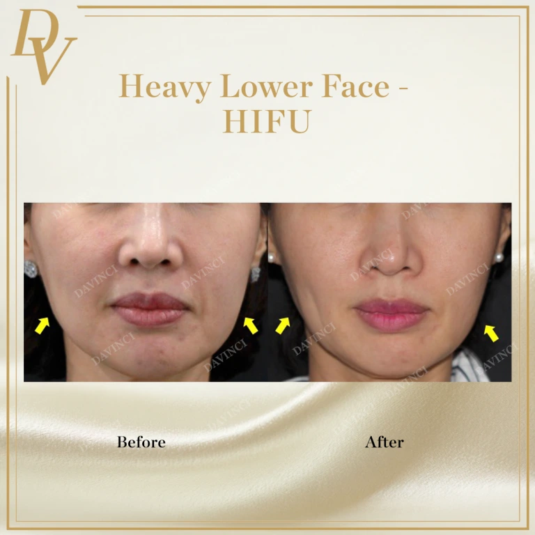 HIFU Facelift treatment in Malaysia at Da Vinci Skin & Aesthetic Clinic