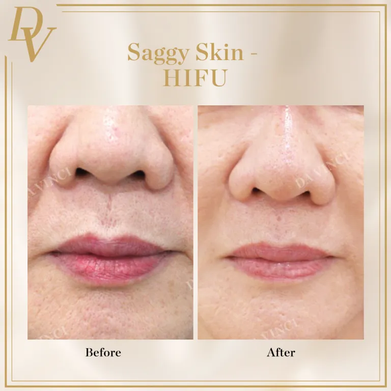 HIFU Facelift treatment for saggy skin or fine lines