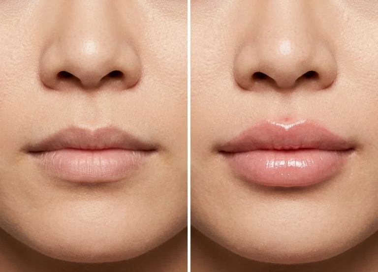Dermal Fillers for Lips in Malaysia at Da Vinci Clinic Malaysia