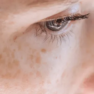 Remove pigmentation with Pico Lasers at Da Vinci Skin & Aesthetic Clinic Malaysia
