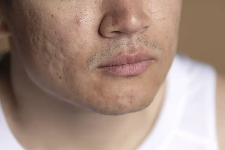 acne scar treatment for smoother skin in kuala lumpur