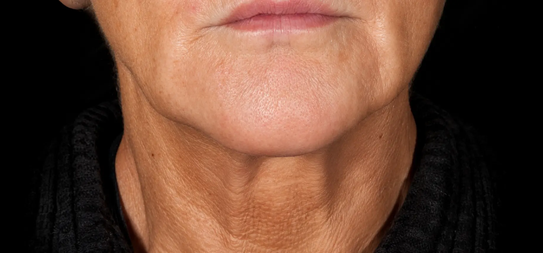 After XERF treatment