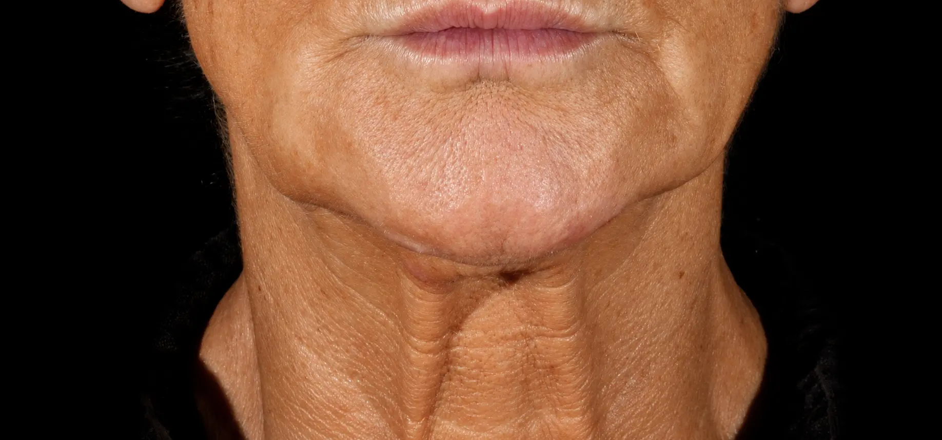 Before XERF treatment