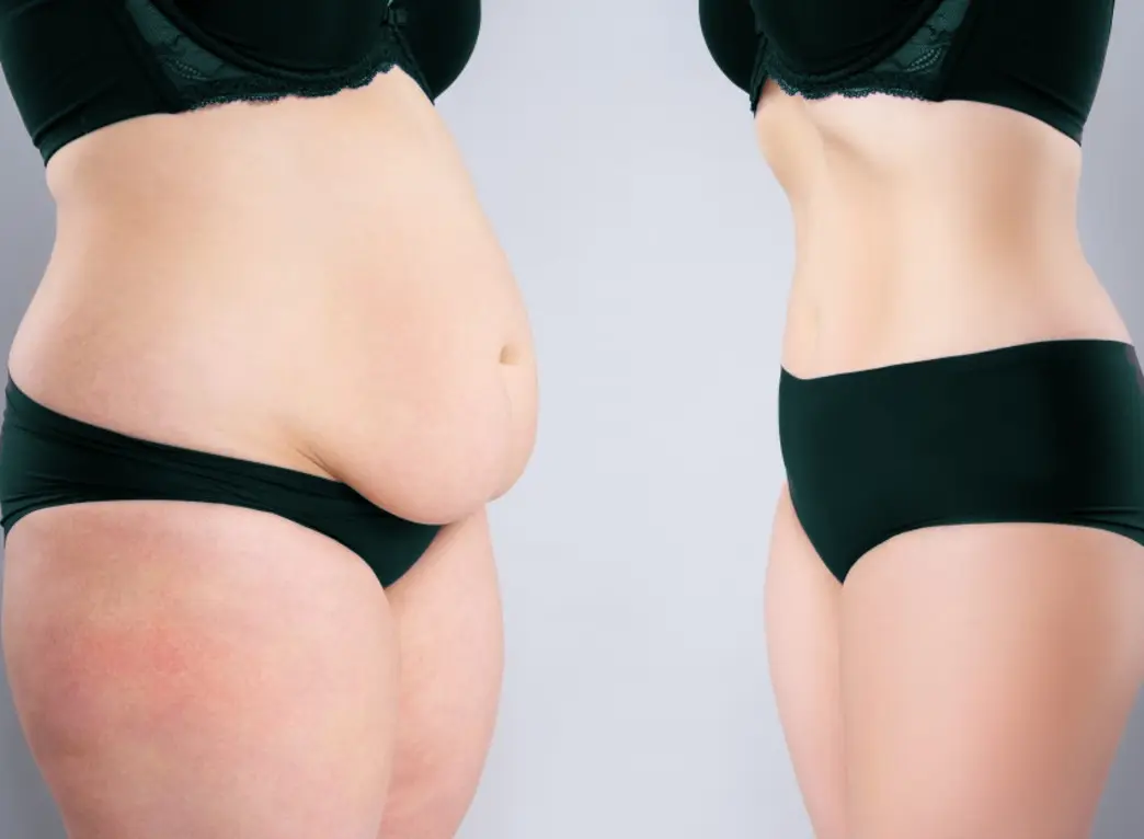 Body sculpting — sculpted silhouette