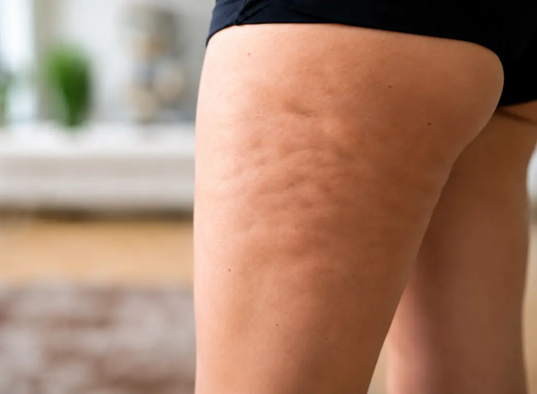 Cellulite — smoother thigh / buttock skin