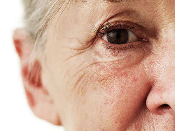 Collagen depletion