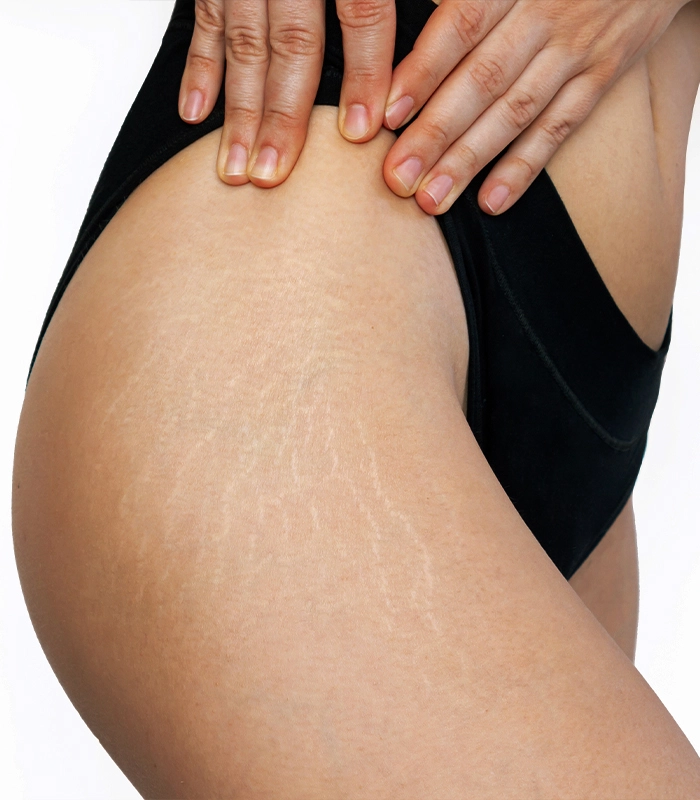 Image of Stretch Marks on Thigh and Treatments available at Da Vinci Skin & Aesthetic Clinic in Malaysia