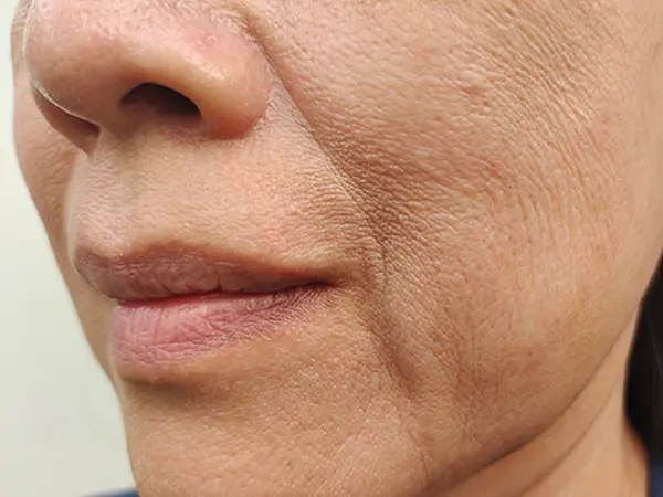 Skin laxity