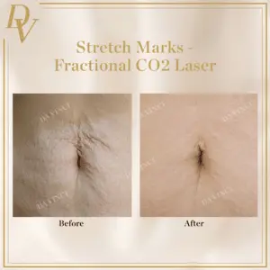 Stretch Marks Removal at Da Vinci Skin & Aesthetic Clinic in Malaysia