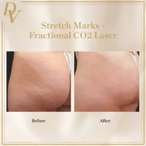 Da Vinci Skin & Aesthetic Clinic Before & After Image of Stretch Marks Removal with Co2 Laser