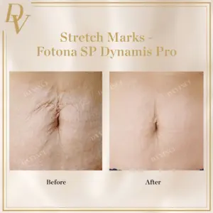 Da Vinci Skin & Aesthetic Clinic Before & After Image of Stretch Marks Removal with Fotona SP Laser