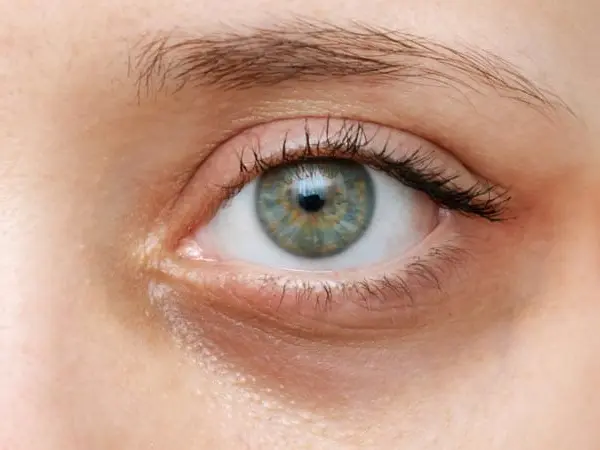 Under-eye hollows