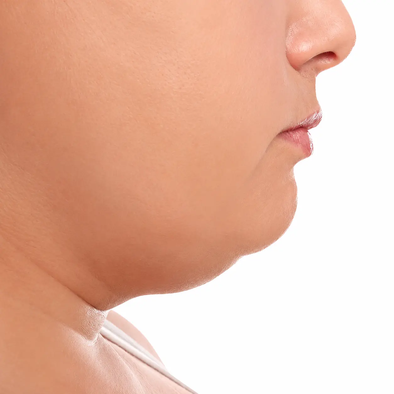 Double chin and submental tissue