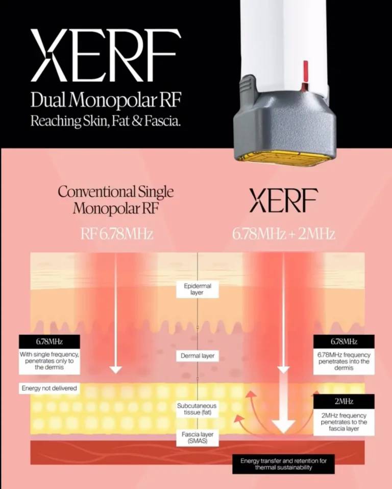 XERF Dual Monopolar Radiofrequency Energy at Da Vinci Skin & Aesthetic Clinic