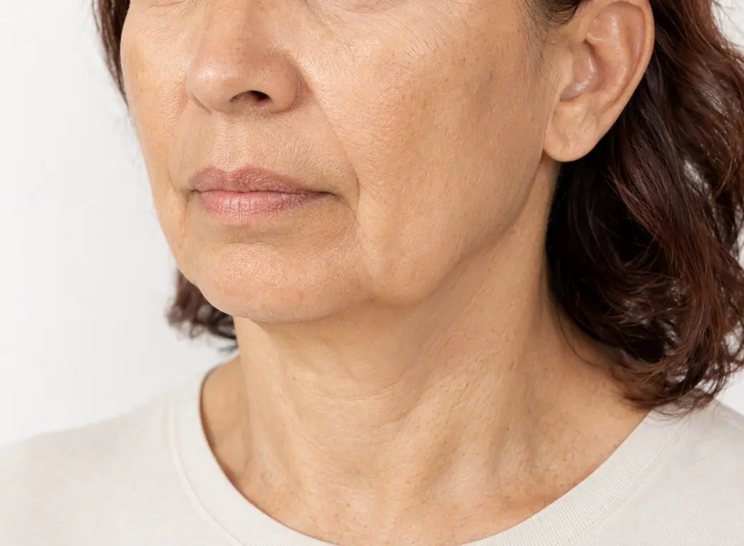 Skin laxity — firm, toned skin